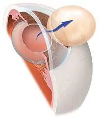 Cross-section diagram of a human eye.