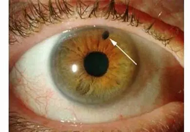 Close-up of an eye with iris nevus.