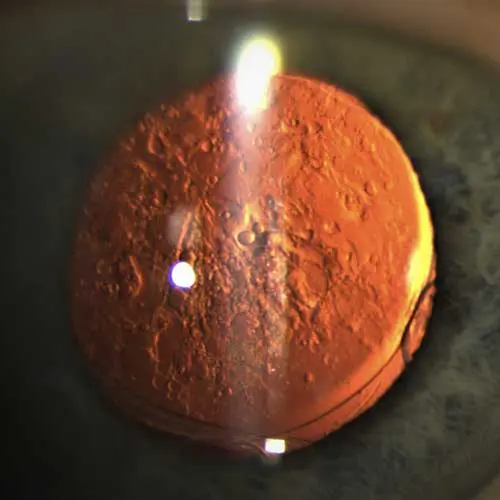 Close-up of an orange contact lens.
