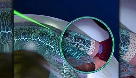 Eye surgery illustration with magnified section.