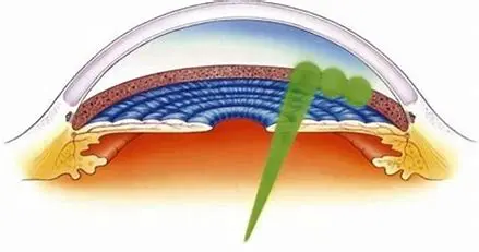 Cross-section illustration of an eye structure.