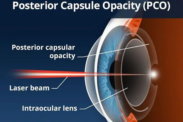 Diagram of Posterior Capsule Opacity treatment.