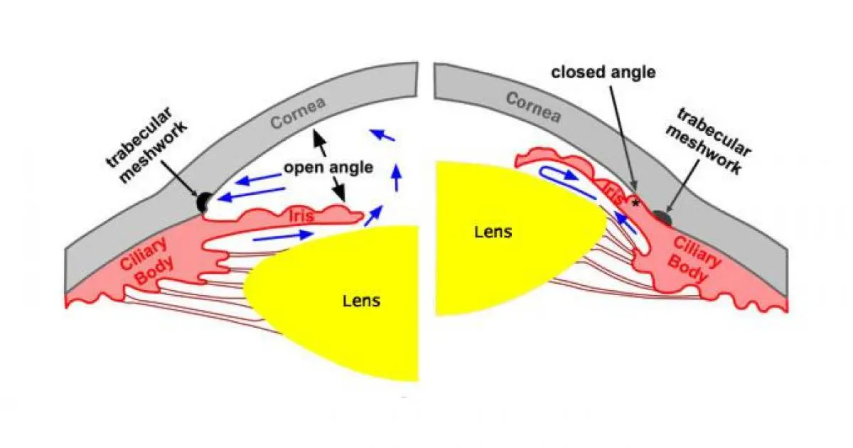 Diagram of open and closed angle glaucoma.