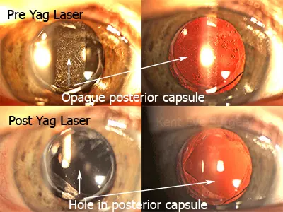 Eye before and after YAG laser treatment.