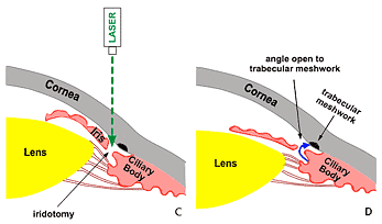 narrow-angles- pic 2